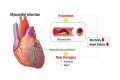 What does the medical term infarct mean?